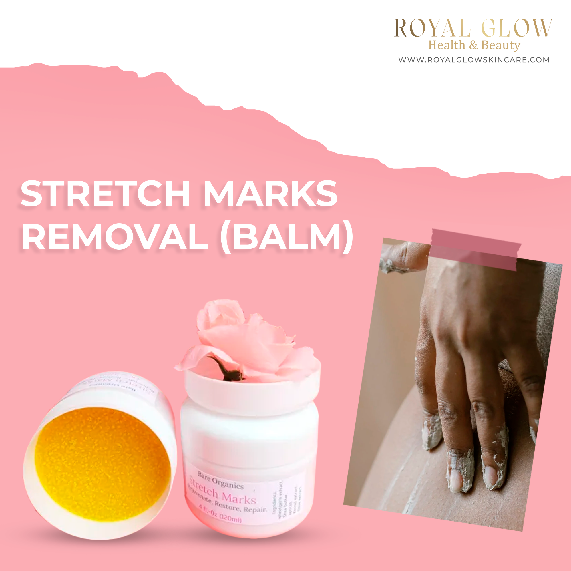 Stretch Marks Removal (balm Kismet Beauty Brands