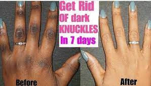 Dark knuckles cream, Potent  Cream , Dark Spots remover, Real results