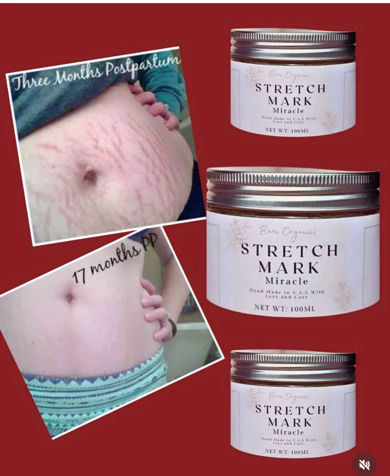 OMEGA-A STRETCH MARKS AND SCAR CREAM