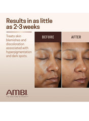 Ambi Even & Clear Fade Cream, Hyperpigmentation Treatment, Dark Spot Corrector.