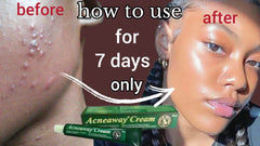 ZERO ACNE ANTISEPTIC CREAM FACIAL DARK SPOT AND ACNE SCARS