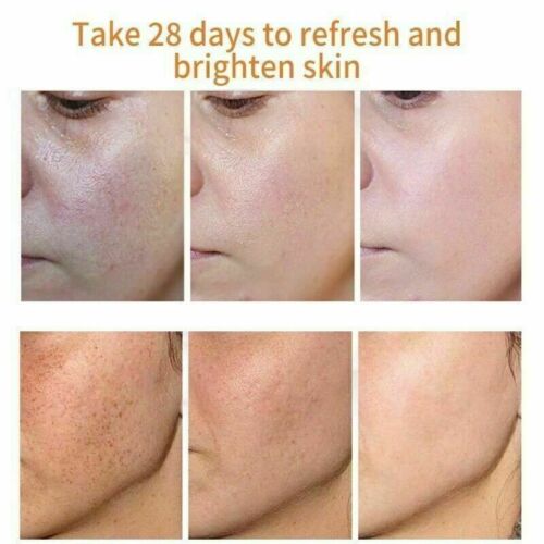 PURE NOMARKS CREAM SPOT REMOVER ANTI MARQUE STRETCH WITH GLUTAWHITE & KOJIC ACID royalglow organics