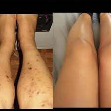 Shenic Perfect Leg Stage 2 Result In 3days RoyalGlow Organics