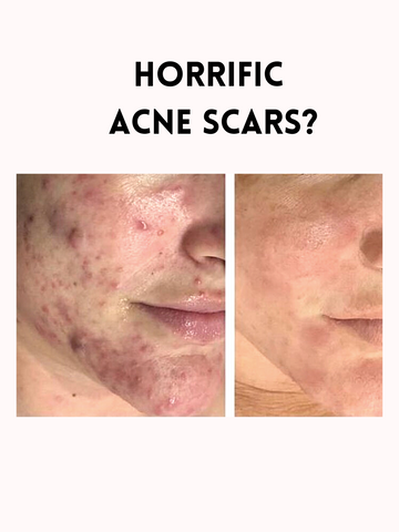 S.O.S. ZERO ACNE ANTISEPTIC CREAM FACIAL DARK SPOT AND ACNE SCARS RoyalGlow Organics