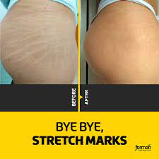 PURE NOMARKS CREAM SPOT REMOVER ANTI MARQUE STRETCH WITH GLUTAWHITE & KOJIC ACID royalglow organics